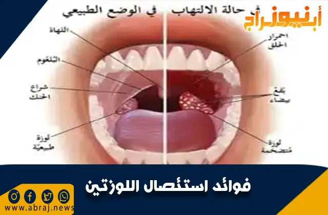 فوائد استئصال اللوزتين