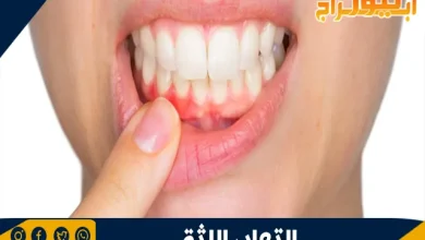 التهاب اللثة