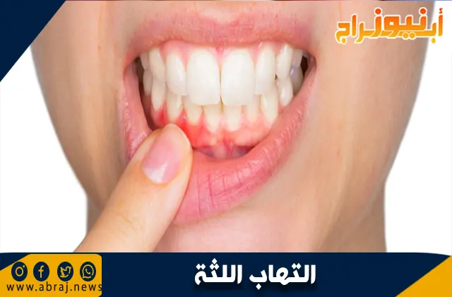 التهاب اللثة